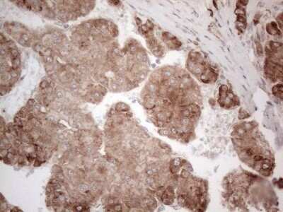 Immunohistochemistry: Jagged 1 Antibody (OTI3A10) - Azide and BSA Free [NBP2-70115] - Analysis of Carcinoma of Human liver tissue.(Heat-induced epitope retrieval by 1mM EDTA in 10mM Tris buffer (pH8.5) at 120C for 3 min)