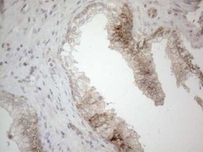 Immunohistochemistry: Jagged 1 Antibody (OTI3A10) - Azide and BSA Free [NBP2-70115] - Analysis of Carcinoma of Human prostate tissue. (Heat-induced epitope retrieval by 1mM EDTA in 10mM Tris buffer (pH8.5) at 120C for 3 min)