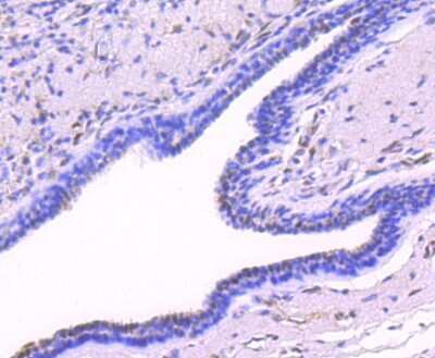 Immunohistochemistry-Paraffin: JunD [p Ser255] Antibody (JJ08-21) [NBP2-67861] - Analysis of paraffin-embedded human breast carcinoma tissue using anti-Phospho-JunD(S255) antibody. Counter stained with hematoxylin.