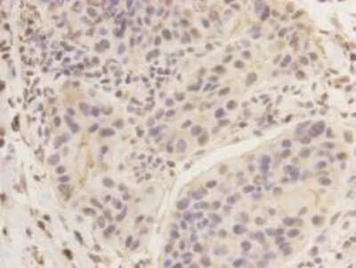 Immunohistochemistry-Paraffin: K0100 Antibody (A0-F3) [NBP2-66915] - Analysis of paraffin- embedded human breast carcinoma tissue using anti-KIAA0100 Mouse mAb.