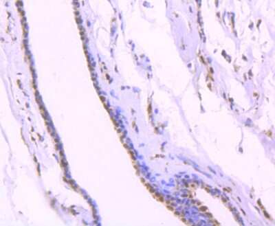 Immunohistochemistry-Paraffin: KAP1 Antibody (SD081-05) [NBP2-67786] - Analysis of paraffin-embedded human breast carcinoma tissue using anti-KAP1 antibody. Counter stained with hematoxylin.