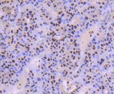 Immunohistochemistry-Paraffin: KAP1 Antibody (SD081-05) [NBP2-67786] - Analysis of paraffin-embedded human liver cancer tissue using anti-KAP1 antibody. Counter stained with hematoxylin.