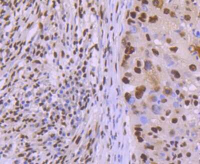 Immunohistochemistry-Paraffin: KAP1 Antibody (SD081-05) [NBP2-67786] - Analysis of paraffin-embedded human lung cancer tissue using anti-KAP1 antibody. Counter stained with hematoxylin.