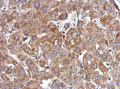 Immunohistochemistry-Paraffin: KCTD3 Antibody [NBP2-17032] - Immunohistochemical analysis of paraffin-embedded Hepatoma, using antibody at 1:500 dilution.