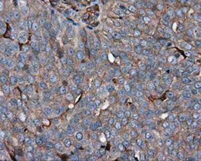Immunohistochemistry-Paraffin: KCTD5 Antibody (3C8) [NBP2-02414] - Staining of paraffin-embedded Adenocarcinoma of ovary tissue using anti-RC200180 mouse monoclonal antibody.