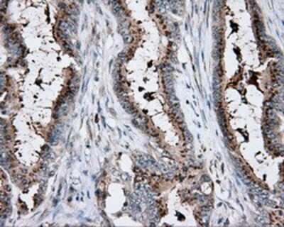 Immunohistochemistry: KCTD5 Antibody (OTI3C8) - Azide and BSA Free [NBP2-71955] - Staining of paraffin-embedded Adenocarcinoma of colon tissue using anti-RC200180 mouse monoclonal antibody.