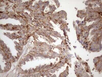 Immunohistochemistry: KCTD9 Antibody (OTI2G8) - Azide and BSA Free [NBP2-71968] - Analysis of Adenocarcinoma of Human ovary tissue.(Heat-induced epitope retrieval by 1mM EDTA in 10mM Tris buffer (pH8.5) at 120C for 3 min)