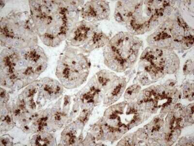 Immunohistochemistry: KCTD9 Antibody (OTI2G8) - Azide and BSA Free [NBP2-71968] - Analysis of Carcinoma of Human liver tissue.(Heat-induced epitope retrieval by 1mM EDTA in 10mM Tris buffer (pH8.5) at 120C for 3 min)