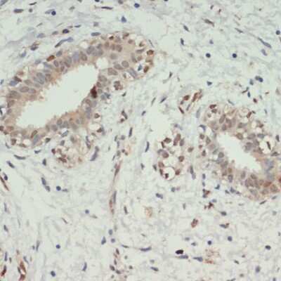 Immunohistochemistry-Paraffin: KDM6A Antibody [NBP3-05103] - Paraffin-embedded human breast cancer using KDM6A antibody at dilution of 1:200 (40x lens).