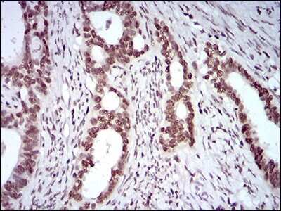 Immunohistochemistry: KHDRBS2 Antibody (7G8C10) [NBP2-37254] - Immunohistochemical analysis of paraffin-embedded cervical cancer tissues using KHDRBS2 mouse mAb with DAB staining.