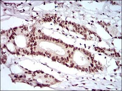 Immunohistochemistry: KHDRBS2 Antibody (7G8C10) [NBP2-37254] - Immunohistochemical analysis of paraffin-embedded colon cancer tissues using KHDRBS2 mouse mAb with DAB staining.