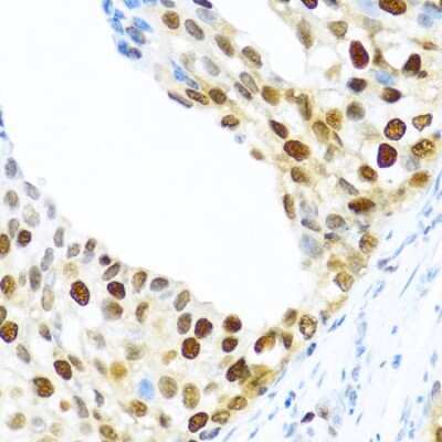 Immunohistochemistry-Paraffin: KHDRBS2 Antibody [NBP3-03933] - Paraffin-embedded human prostate cancer using KHDRBS2 antibody at dilution of 1:100 (40x lens).