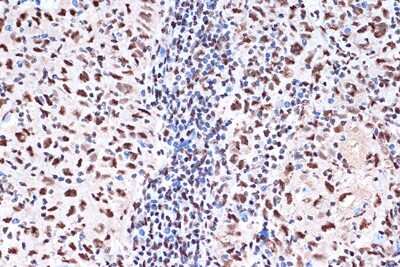 Immunohistochemistry-Paraffin: KHSRP Antibody (4V4O1) [NBP3-16746] - Immunohistochemistry of paraffin-embedded human esophageal cancer using KHSRP Rabbit mAb (NBP3-16746) at dilution of 1:100 (40x lens).Perform microwave antigen retrieval with 10 mM Tris/EDTA buffer pH 9.0 before commencing with IHC staining protocol.