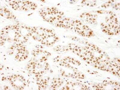 Immunohistochemistry-Paraffin: KHSRP Antibody [NBP1-18911] - Human breast carcinoma. Antibody: Affinity purified rabbit anti-KSRP used at a dilution of 1:1,000 (1ug/ml). Detection: DAB