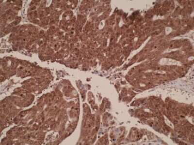 Immunohistochemistry: KIAA1199 Antibody (V98P4E1/B7) [NBP2-50336] - Staining of colorectal cancer tissue sections. Strong cytoplasmic and nuclear staining were detected.