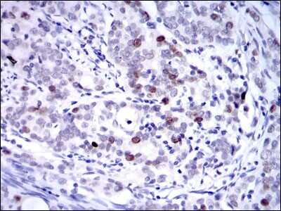 Immunohistochemistry: KIF22 Antibody (5F3) [NBP2-37552] - Immunohistochemical analysis of paraffin-embedded cervical cancer tissues using KID mouse mAb with DAB staining.