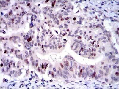 Immunohistochemistry: KIF22 Antibody (5F3) [NBP2-37552] - Immunohistochemical analysis of paraffin-embedded rectum cancer tissues using KID mouse mAb with DAB staining.