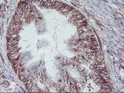 Immunohistochemistry: KIF2C Antibody (OTI1C5) - Azide and BSA Free [NBP2-71667] - Staining of paraffin-embedded Adenocarcinoma of Human endometrium tissue using anti-KIF2C mouse monoclonal antibody.