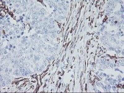 Immunohistochemistry: KIF2C Antibody (OTI1C5) - Azide and BSA Free [NBP2-71667] - Staining of paraffin-embedded Adenocarcinoma of Human ovary tissue using anti-KIF2C mouse monoclonal antibody.