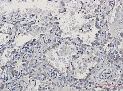 Immunohistochemistry-Paraffin: KIFAP3 Antibody (S03-6C6) [NBP3-19882] - Immunohistochemistry of KIFAP3 in paraffin-embedded Human lung cancer tissue using NBP3-19882 at dilution 1/50