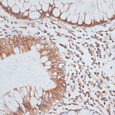 Immunohistochemistry-Paraffin: KIFC1 Antibody [NBP3-04585] - Paraffin-embedded human colon carcinoma using KIFC1 antibody at dilution of 1:100 (40x lens).