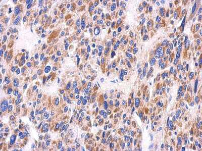 Immunohistochemistry-Paraffin: KIR2DS2 Antibody [NBP2-15004] - Paraffin-embedded Hepatoma, using antibody at 1:500 dilution.