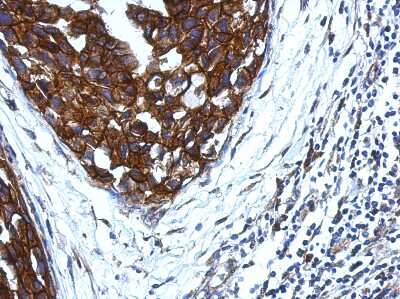 Immunohistochemistry-Paraffin: KIR2DS4 Antibody [NBP2-15006] - Paraffin-embedded Breast ca, using antibody at 1:500 dilution.