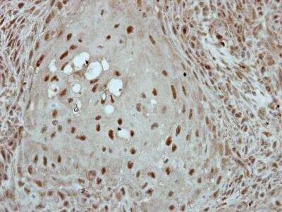 Immunohistochemistry-Paraffin: KLF3 Antibody [NBP2-15008] - Paraffin-embedded SCC4 xenograft, using antibody at 1:100 dilution.