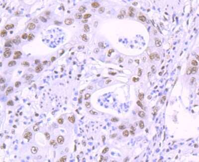 Immunohistochemistry-Paraffin: KLF4 Antibody (JF98-08) [NBP2-66918] - Analysis of paraffin-embedded human gastric carcinoma tissue using anti-KLF4 antibody. Counter stained with hematoxylin.