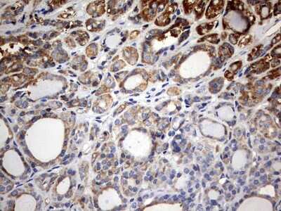 Immunohistochemistry: KLHL12/C3IP1 Antibody (4E1) [NBP2-45512] - Analysis of Carcinoma of Human thyroid tissue. (Heat-induced epitope retrieval by 10mM citric buffer, pH6.0, 120C for 3min)