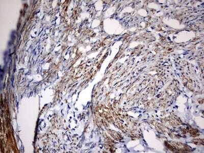 Immunohistochemistry: KLHL12/C3IP1 Antibody (4E1) [NBP2-45512] - Analysis of Adenocarcinoma of Human endometrium tissue. (Heat-induced epitope retrieval by 10mM citric buffer, pH6.0, 120C for 3min)