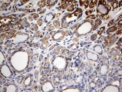 Immunohistochemistry: KLHL12/C3IP1 Antibody (OTI4E1) - Azide and BSA Free [NBP2-72118] - Analysis of Carcinoma of Human thyroid tissue. (Heat-induced epitope retrieval by 10mM citric buffer, pH6.0, 120C for 3min)