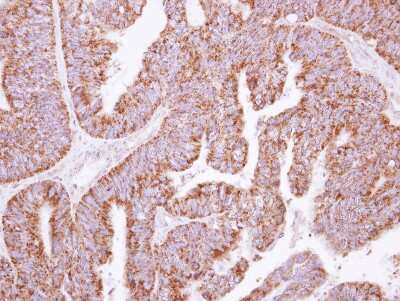 Immunohistochemistry-Paraffin: KLHL2 Antibody [NBP2-17080] - Human colon carcinoma, using KLHL2 antibody at 1:500 dilution. Antigen Retrieval: Trilogy™ (EDTA based, pH 8.0) buffer, 15min.