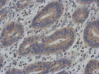 Immunohistochemistry-Paraffin: KLHL25 Antibody [NBP2-17082] - Immunohistochemical analysis of paraffin-embedded Colon ca, using antibody at 1:500 dilution.
