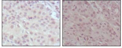 Immunohistochemistry-Paraffin: KMT2A/MLL Antibody (10F8D7) [NBP1-51542] - Immunohistochemical analysis of paraffin-embedded human lung cancer (left) and esophagus cancer (right), showing nuclear weak staining with DAB staining using MLL mouse mAb.