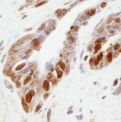 Immunohistochemistry-Paraffin: KMT3B/NSD1 Antibody [NB100-1744] - Sample : FFPE section of human prostate adenocarcinoma. Antibody: Affinity purified rabbit anti-NSD1 used at a dilution of 1:250. Detection: DAB