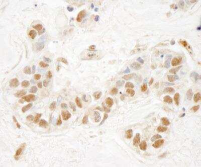 Immunohistochemistry-Paraffin: KMT3B/NSD1 Antibody [NB100-1744] - Sample: FFPE section of human breast carcinoma. Antibody: Affinity purified rabbit anti-NSD1 used at a dilution of 1:250. Detection: DAB staining using Immunohistochemistry Accessory Kit .