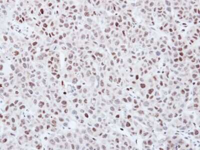 Immunohistochemistry-Paraffin: KPNA3 Antibody [NBP1-31031] - Paraffin-embedded KYSE170 xenograft, using antibody at 1:500 dilution.