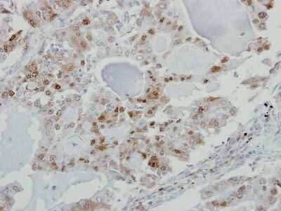 Immunohistochemistry-Paraffin: KPNA3 Antibody [NBP2-17088] - Immunohistochemical analysis of paraffin-embedded lung AdCA, using antibody at 1:500 dilution.