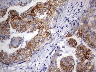 Immunohistochemistry: KRT24 Antibody (4E8) [NBP2-45558] - Analysis of Carcinoma of Human liver tissue.(Heat-induced epitope retrieval by 1 mM EDTA in 10mM Tris, pH9.0, 120C for 3min)