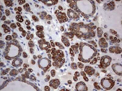 Immunohistochemistry: KRT24 Antibody (4E8) [NBP2-45558] - Analysis of Carcinoma of Human thyroid tissue. (Heat-induced epitope retrieval by 1 mM EDTA in 10mM Tris, pH9.0, 120C for 3min)