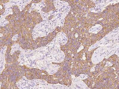 Immunohistochemistry-Paraffin: KRT24 Antibody [NBP2-99291] - Immunochemical staining of human KRT24 in human breast carcinoma with rabbit polyclonal antibody at 1:2000 dilution, formalin-fixed paraffin embedded sections.