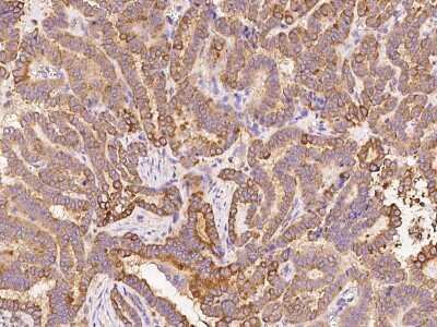 Immunohistochemistry-Paraffin: KRT24 Antibody [NBP2-99291] - Immunochemical staining of human KRT24 in human thyroid carcinoma with rabbit polyclonal antibody at 1:1000 dilution, formalin-fixed paraffin embedded sections.