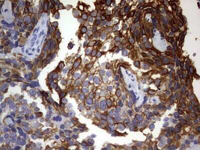 Immunohistochemistry: KRT24 Antibody (OTI4E8) - Azide and BSA Free [NBP2-72455] - Analysis of Adenocarcinoma of Human breast tissue. (Heat-induced epitope retrieval by 1 mM EDTA in 10mM Tris, pH9.0, 120C for 3min)