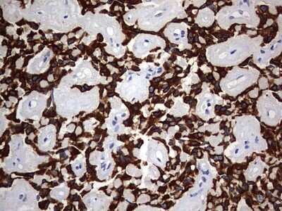 Immunohistochemistry: KRT24 Antibody (OTI4E8) - Azide and BSA Free [NBP2-72455] - Analysis of Carcinoma of Human pancreas tissue. (Heat-induced epitope retrieval by 1 mM EDTA in 10mM Tris, pH9.0, 120C for 3min)