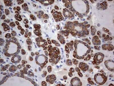 Immunohistochemistry: KRT24 Antibody (OTI4E8) - Azide and BSA Free [NBP2-72455] - Analysis of Carcinoma of Human thyroid tissue. (Heat-induced epitope retrieval by 1 mM EDTA in 10mM Tris, pH9.0, 120C for 3min)