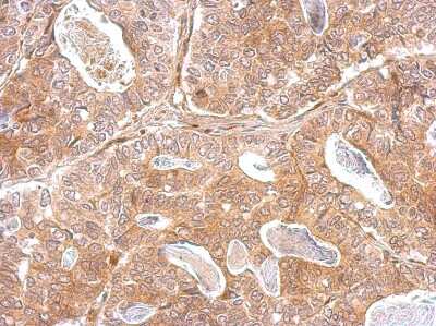 Immunohistochemistry-Paraffin: Kallikrein 2 Antibody [NBP1-32288] -  Gastric cancer. Kallikrein 2 antibody [N3C3] dilution: 1:500. Antigen Retrieval: Trilogy™ (EDTA based, pH 8.0) buffer, 15min.