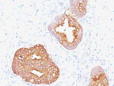 Immunohistochemistry-Paraffin: Kallikrein 3/PSA Antibody (1A7 (same as 1A7G6B6)) - Azide and BSA Free [NBP2-47968] - Human Prostate Carcinoma stained with Prostate Specific Antigen Mouse Monoclonal Antibody (1A7).