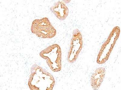 Immunohistochemistry-Paraffin: Kallikrein 3/PSA Antibody (A67-B/E3) - IHC-Prediluted [NBP2-44884] - Formalin-fixed, paraffin-embedded human prostate carcinoma stained with PSA MAb (A67-B/E3).