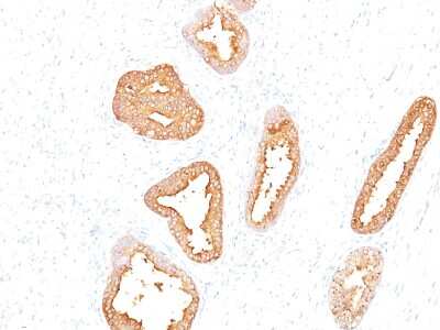 Immunohistochemistry-Paraffin: Kallikrein 3/PSA Antibody (A67-B/E3) [NBP2-32992] - Formalin-fixed, paraffin-embedded human prostate carcinoma stained with PSA MAb (A67-B/E3).